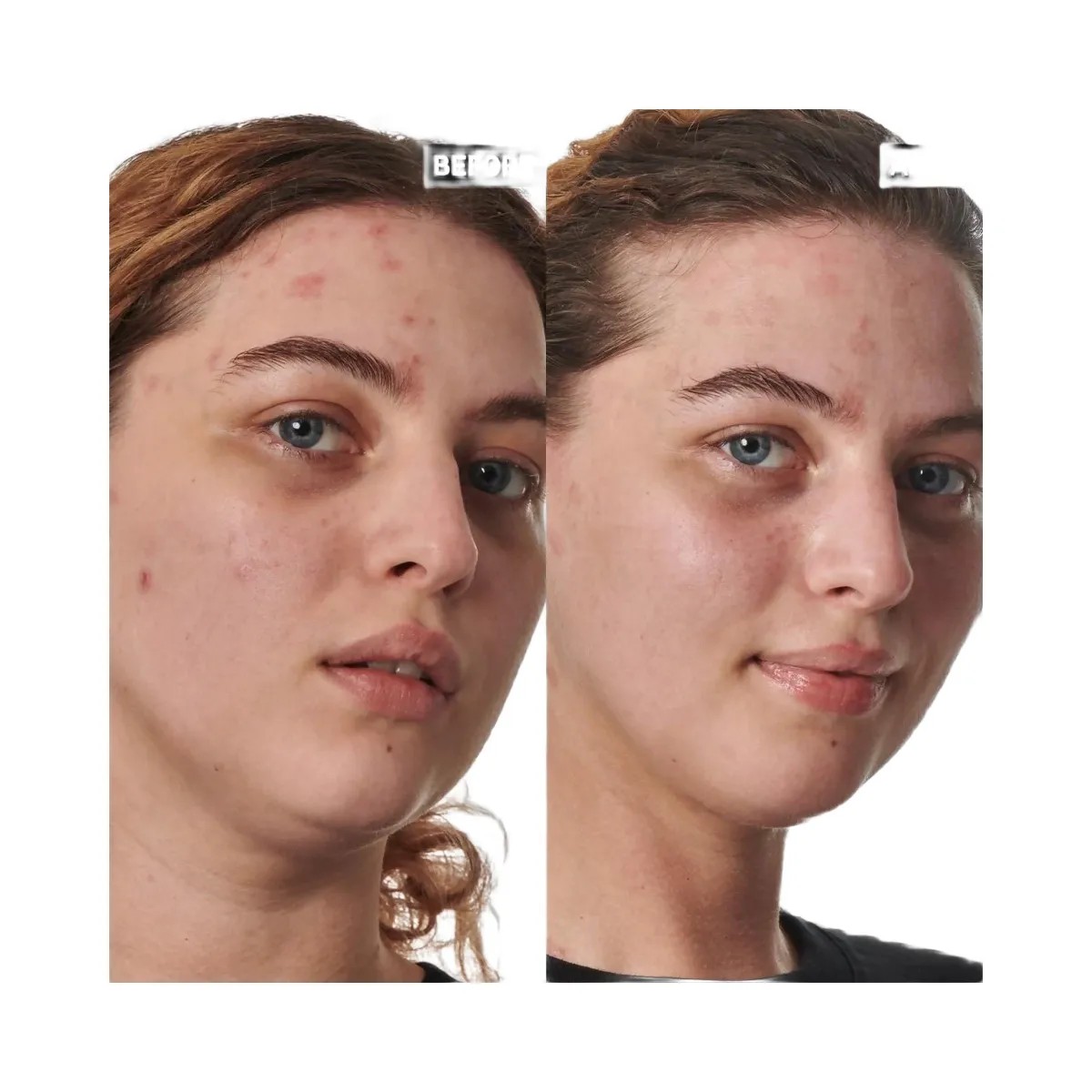 INKEY SuperSolutions 10% Urea Moisturizer Textured Skin Solution - HypeFly India View 4