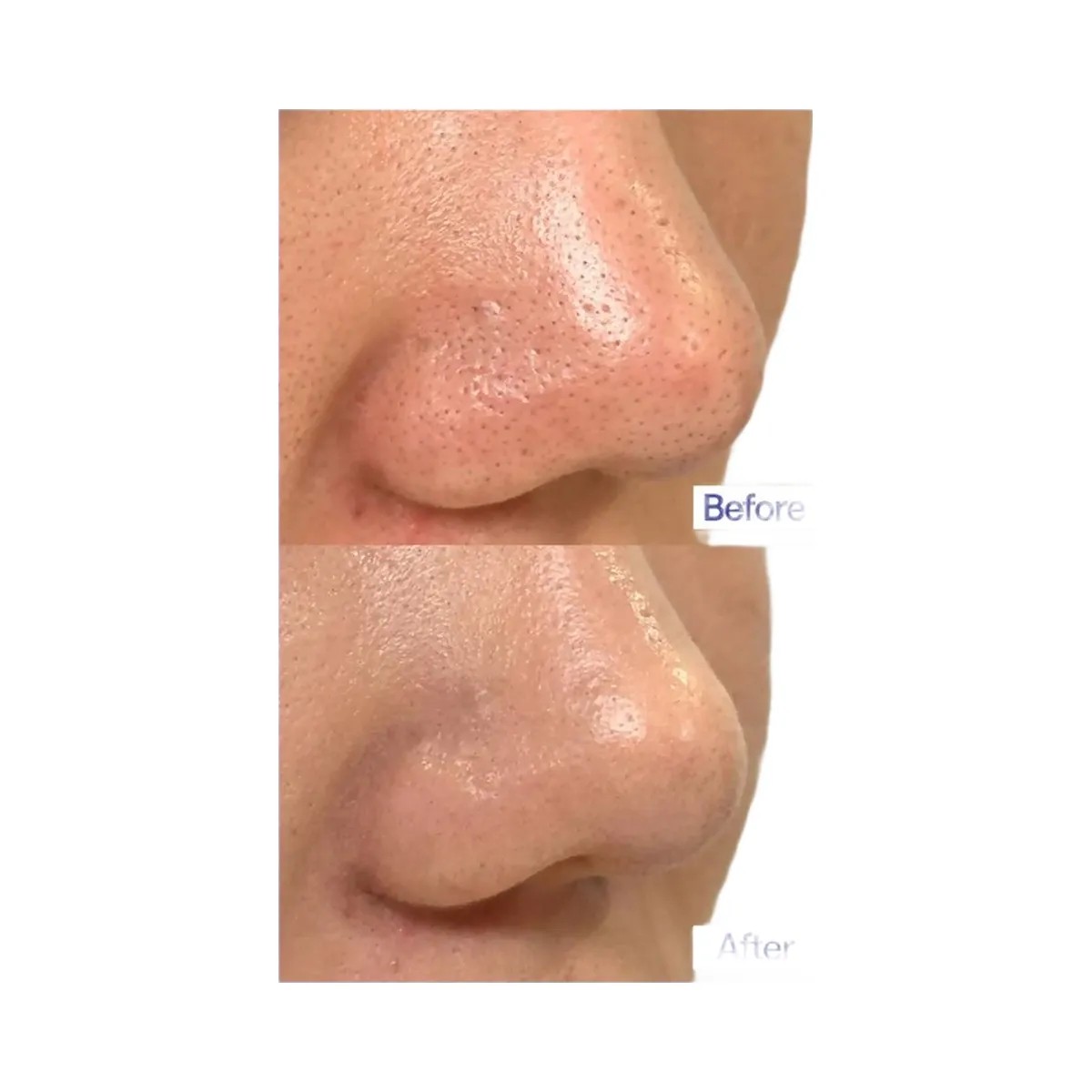MEDIHEAL Blackhead Melting Clear Nose Patch - HypeFly India View 3