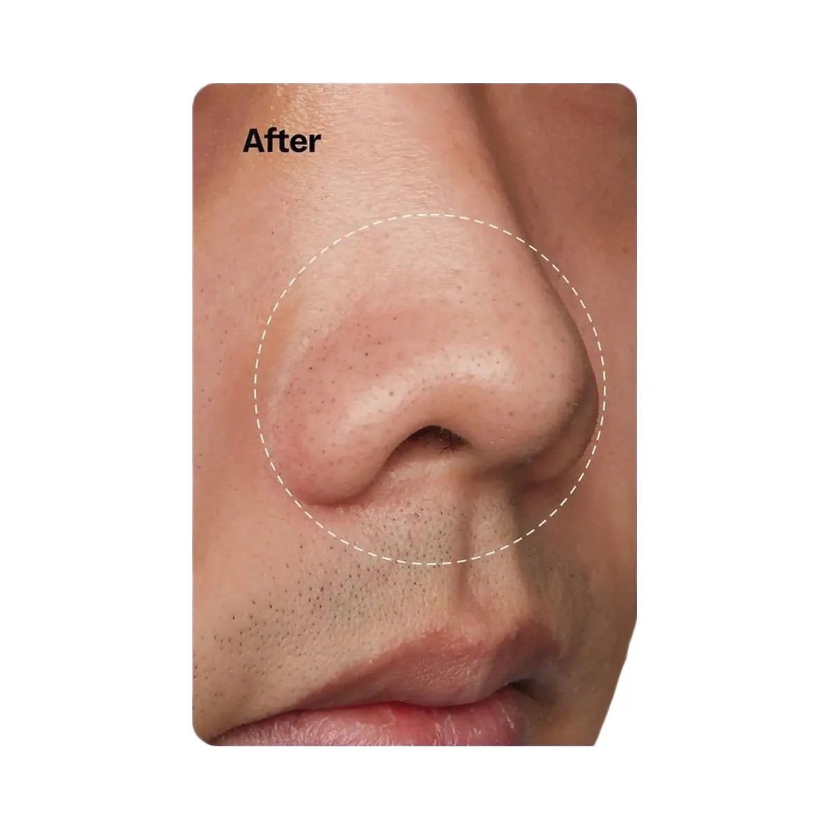 Peach Slices Nose Pore Patches - HypeFly India View 5