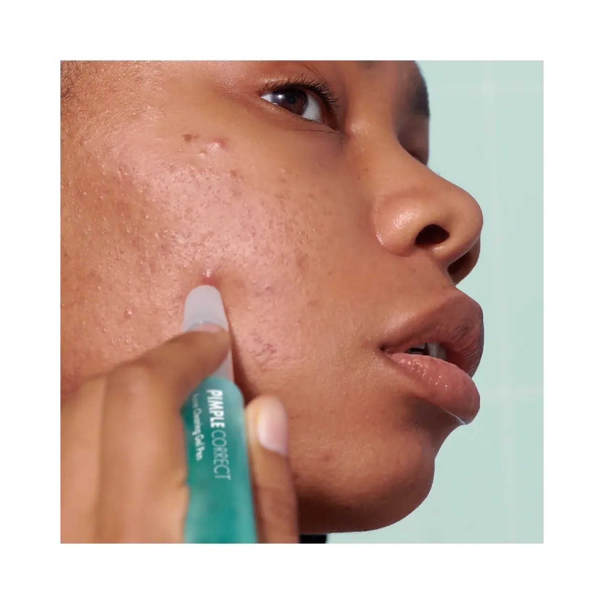 Hero Cosmetics Pimple Correct Acne Clearing Gel Pen - HypeFly India View 4