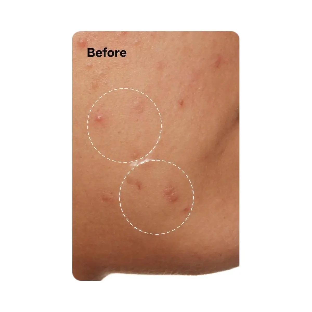 Peach Slices Acne Clarifying Cleanser - HypeFly India View 6