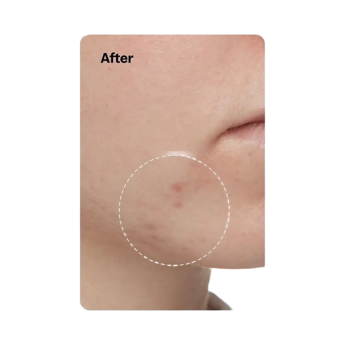 Peach Slices Acne Exfoliating Toner - HypeFly India View 6