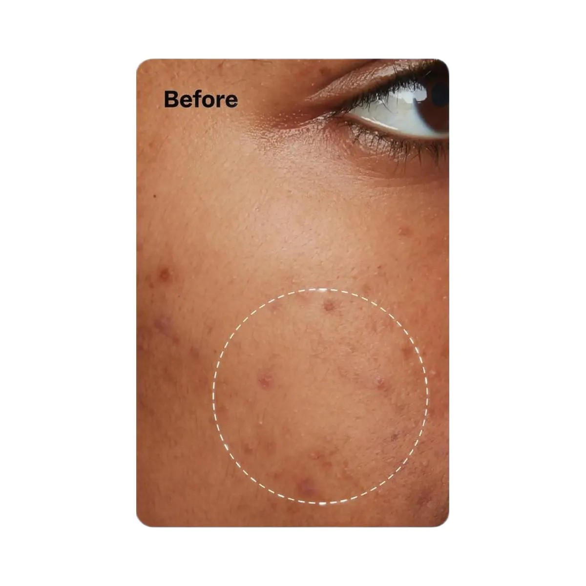 Peach Slices Acne Oil-Free Moisturizer - HypeFly India View 6