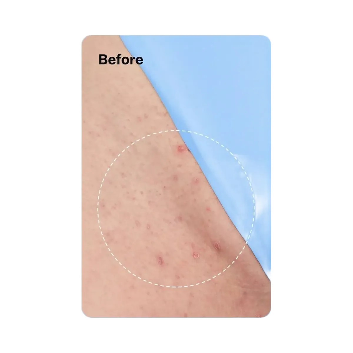 Peach Slices Smoothing Solution Ingrown Hair Treatment - HypeFly India View 5